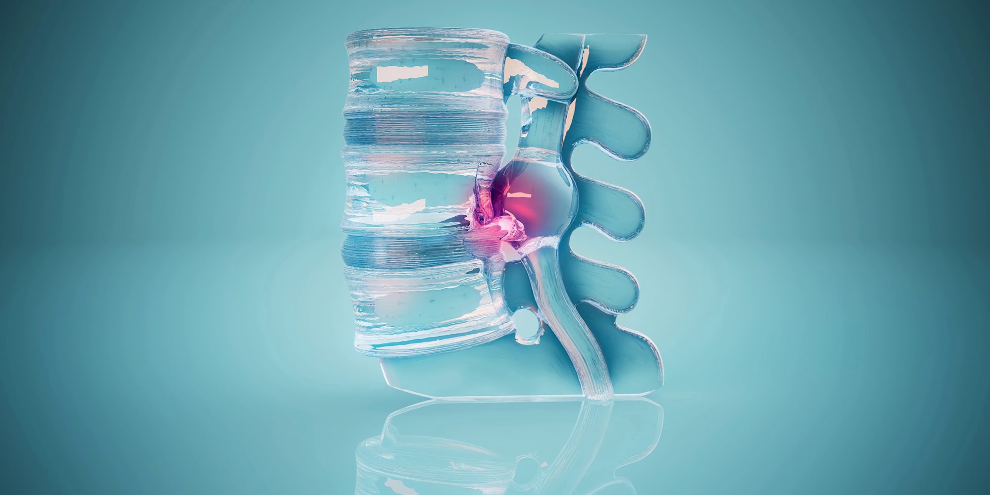 Conceptual 3D illustration of a herniated disk in the lumbar spine