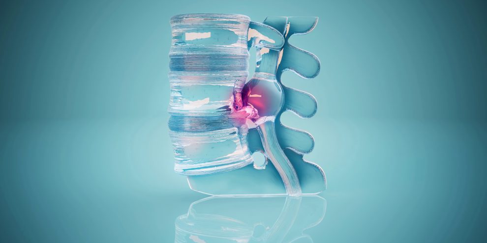 Conceptual 3D illustration of a herniated disk in the lumbar spine